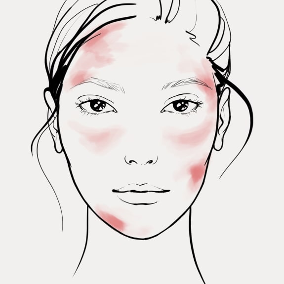 Illustration of a woman's face with atopic dermatitis